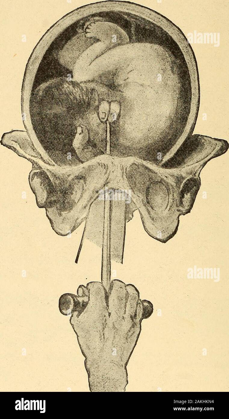 Un infermiere's Handbook of Obstetrics, per l'uso nella formazione-scuole . Fig. 98.-Brauns chiave a gancio. L' eviscerazione è compiuta con la lunga stout scissorsshown in Fig. 100. Dopo qualsiasi forma di consegna operativa il pericolo di post-partum emorragia è sempre di essere particolarmente temuto, e thenurse dovrebbe avere pronto un ampio assortimento di piatti caldi e freddi per sterilewater douches o infusi, nel caso in cui siano necessari e un 198 un infermiere manuale di ostetricia.. Fig. 99.-Brauns gancio applicato. (Garrigues). Foto Stock