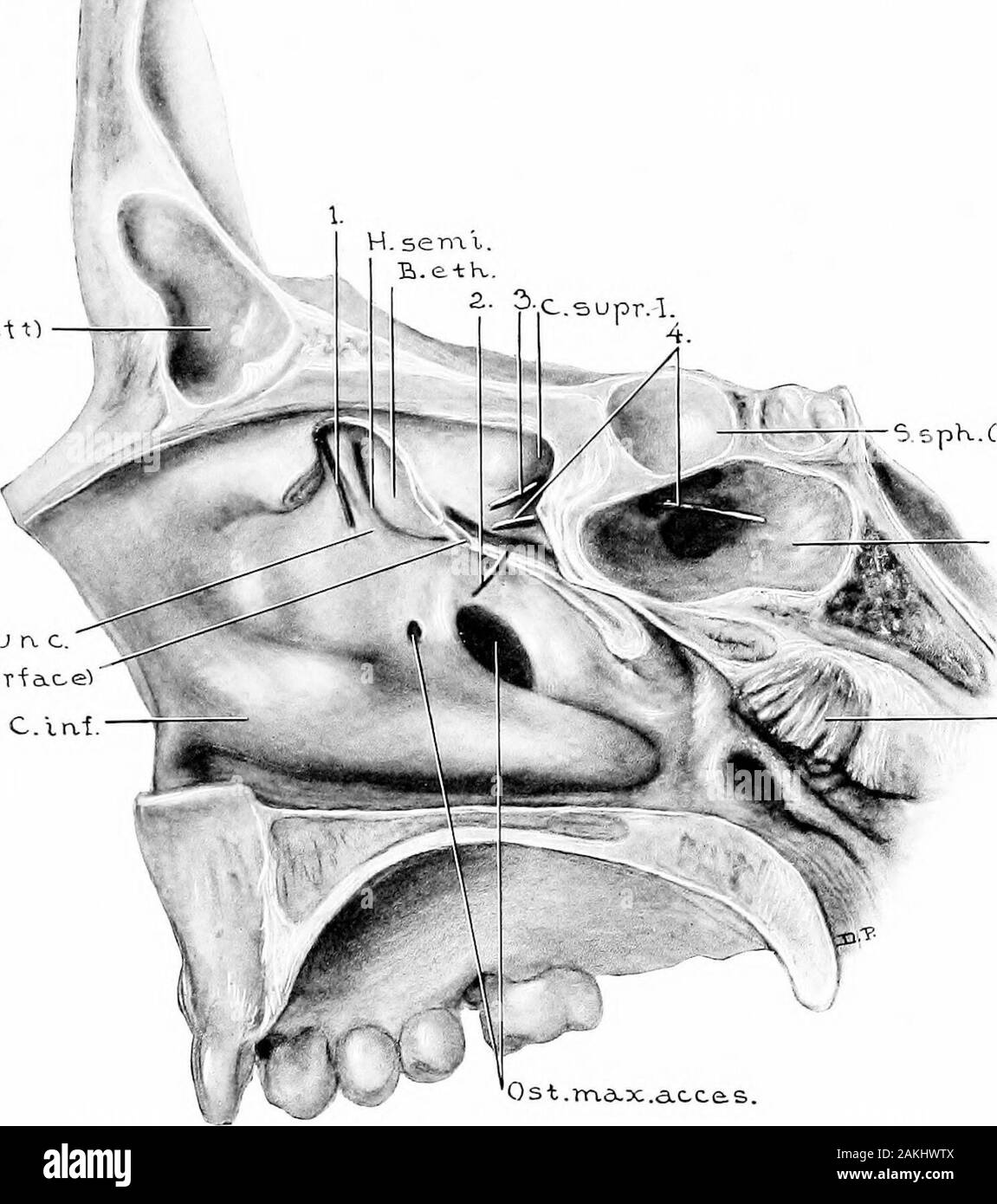 Sviluppo e anatomia dell'accessorio nasale seni nell'uomo; osservazioni basate su duecento novanta laterali pareti nasale, che mostra le varie fasi e i tipi di sviluppo dell'accessorio zone sinusale dal sessantesimo giorno di vita fetale a maturità avanzata . Fig. 47.-modello di sedici anni, cinque mesi e ventuno DaysOld. (Serie D, n. 79.)vista laterale del frontale, ethmoidal, mascellare e una porzione della sphenoidalareas. Seno mascellare contiene cisti mucose. Il crinale che si vede sul pavimento del .sphenoidal sinus sovrasta il nervus canaUs pterygoidei (Vidii).Nota di e Foto Stock