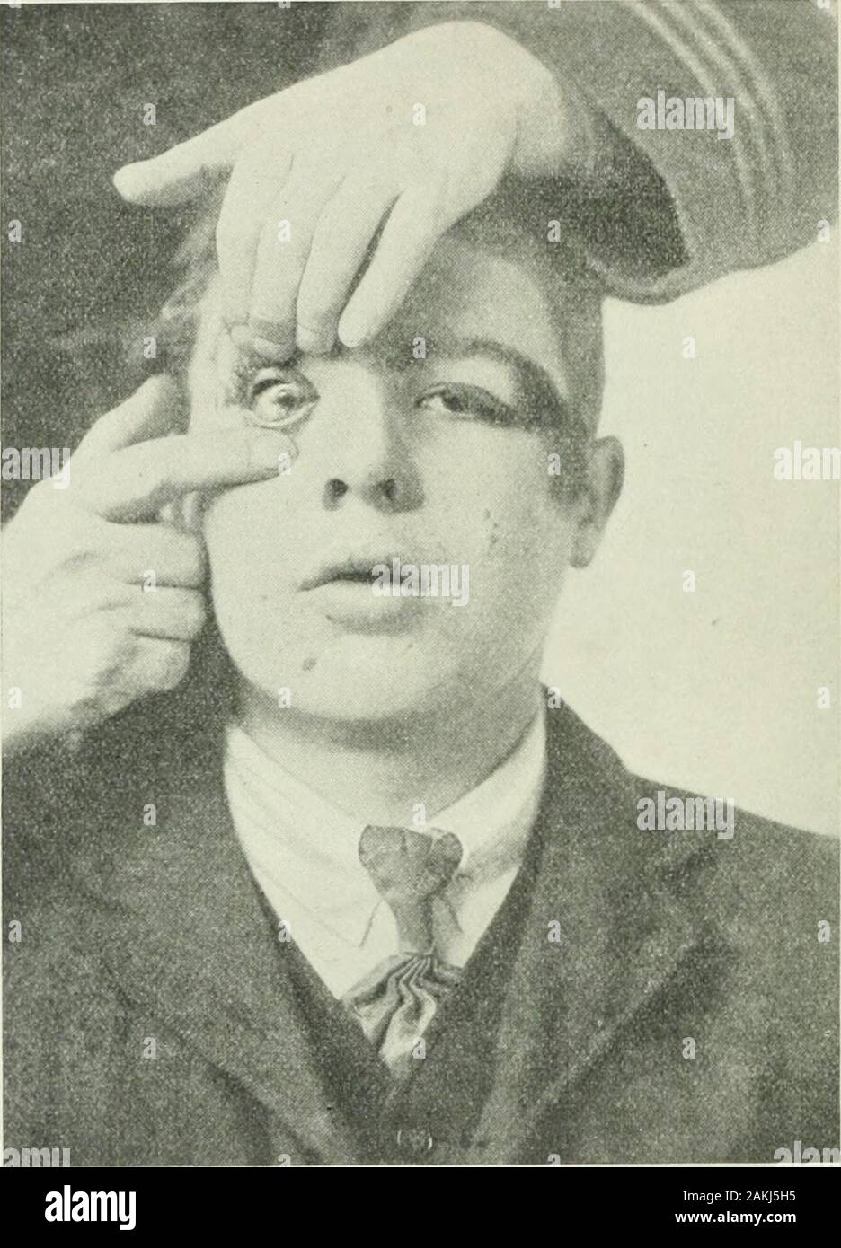 Le transazioni . mid-point di seguito; la parte inferiore e interna beingfree quadrante. Vi è un pigmento al margine di avanzamento della crescita theconjunctival. È questa mole di diventare maligne ? Un piccolo nodulo è presente anche sul bulbo oculare sinistro. 228 malattie delle palpebre e congiuntiva. Fig. 39.. 6. Ccmgenitcd ectrcpion dei coperchi hnrer. Da E. Trkacher Collins. Lilly F-, è stato portato a me prima a MoorfieldsHospital su luglio 18tli, 1910, quando aveva quattro monthsold, a causa di un difetto nel suo palpebre che datedfrom nascita. ECTROPION CONGKNITAL DI THR coperchi inferiore. 229 Su examiiiatiou ella è stato trovato avere par Foto Stock