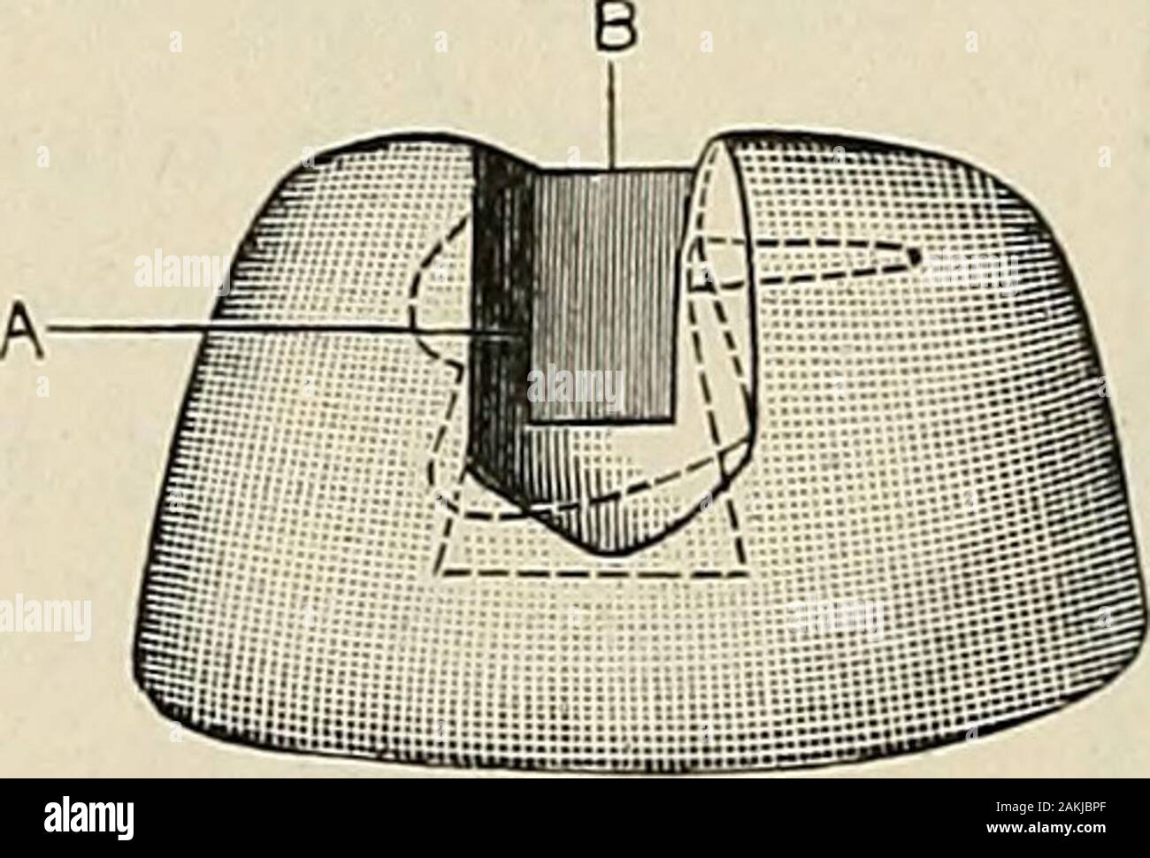 Un pratico trattato sulla meccanica odontoiatria . che si terrà nel corso di un becco Bunsen fino a quando i piccoli pezzi aremelted, quando essi del flusso in queste depressioni e riempire themlevel pieno. L'eccedenza viene rifilata, le cuspidi andfitted massa al bordo della porcellana anteriore, in posizione di occlusione secureproper (Fig. 397), e fissato con la cera come mostrato in figura A. Un pezzo di sottile di oro puro o piastra di mica è quindi regolata oneach lato della corona (B, Fig. 397), le cui superfici, se dryand leggermente tiepido, sarà trattenuto in posizione temporaneamente da pressingthem delicatamente contro il lato della cera. Thi Foto Stock