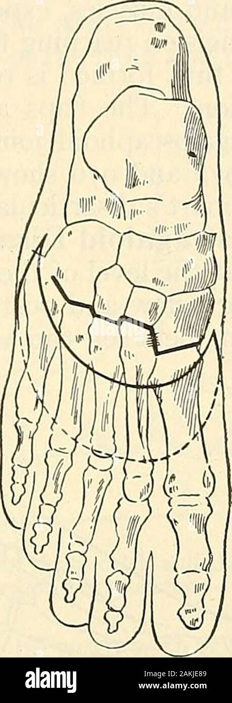 La moderna chirurgia generale e operativo . Fig. 075.-anteriore intertarsal Fig. g76.-Choparts am- Fig. g^^.-^Lisfrancs ampu-disarticolamento (Kocher). notorio (Kocher). tazione (Kocher). dell'peroneus longus muscolo. La pelle-incisioni nel piede sinistro sono begunon il lato interno e in disarticulating l'Articolazione tarsica del grande convergenza è firstopened. La figura 978 mostra le parti dopo una disarticolazione in corrispondenza della linea di Lisfranc.Heys operazione.-Nel metodo Heys l'incisione è praticamente il sameas che per Lisfrancs amputazione. Le quattro esterne le ossa metatarsali sono Foto Stock