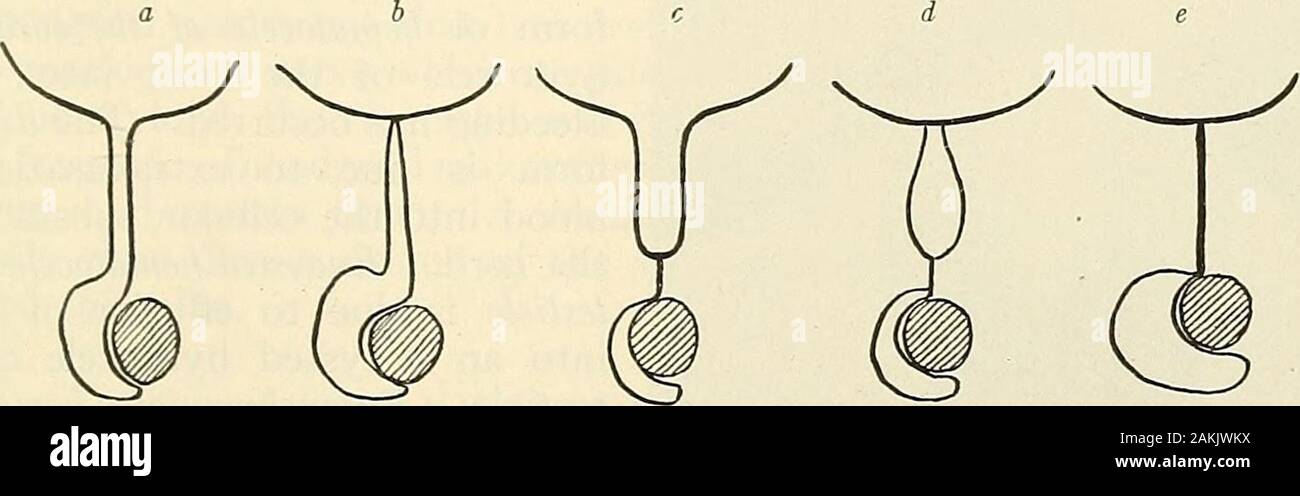 La moderna chirurgia generale e operativo . etin 1898 (Progres Med., Sett. 21, 1901). Doyen e Winklemann fare un simi-lar il funzionamento. Jaboulay, troppo, fautori di scomporre il sac e ruotandolo insideout. Egli ripiega attorno a entrambi il testicolo e del cavo di alimentazione e con le maglie di essa in modo che il•endotheUal liscia la superficie della tunica verrà in contatto con le materie scrotaltissue. Esso dovrà aderire al tessuto scrotale (Chirurgia Keens, vol. iv). Anestetico Alocal viene iniettata e una incisione 2 pollici in lunghezza è fatta. Thetesticle è sollevato dal scrotiun. La sierosa e tutti gli altri rivestimenti pelle exceptthe cadono insieme b Foto Stock