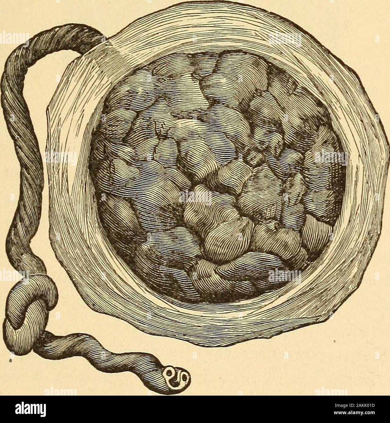 Un infermiere's Handbook of Obstetrics, per l'uso nella formazione-scuole . Fig. 2i.-superficie fetale della placenta. (Garrigues.) la membrana pellicolare circa thecircumference è rotto il sacco amniotico.. Fig. 22,-superficie materna della placenta. (Garrigues.) 5o un infermiere manuale di ostetricia. che sono ritorti su ogni altro e questi sono protetti daun morbido, trasparente, blu-bianco, sostanza gelatinosa chiamato Whartons jelly. Durante i primi mesi di gravidanza il feto, o em-bryo, come è di solito chiamato, non presenta alcuna somiglianza whateverto la forma umana. Al termine delle quattro settimane l'ovulo (Fig.23) ho Foto Stock