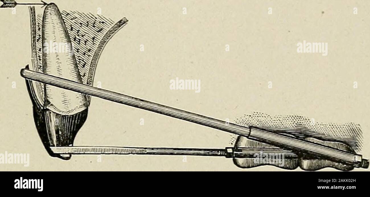 Una pratica sul trattato della odontoiatria meccanica . ) Le fasce devono essere montate le corone di denti incisivi neartheir occlusione di estremità, allo scopo di ottenere una più rigidbearing nella cambiata l'applicazione di forza. (2) Il endsalso inferiore del montante pezzi devono essere effettuate ad abbracciare il fulcro bar.(3) I dadi dovrebbero essere invertite nelle loro posizioni relative a thetubes. (4) la più difficile e altrettanto importante parte di ourtask sarà ora consiste nel muovere le radici del cuspids, se all importante, ma la loro posizione è tale se molta forza è appliedwith la presente disposizione di un Foto Stock