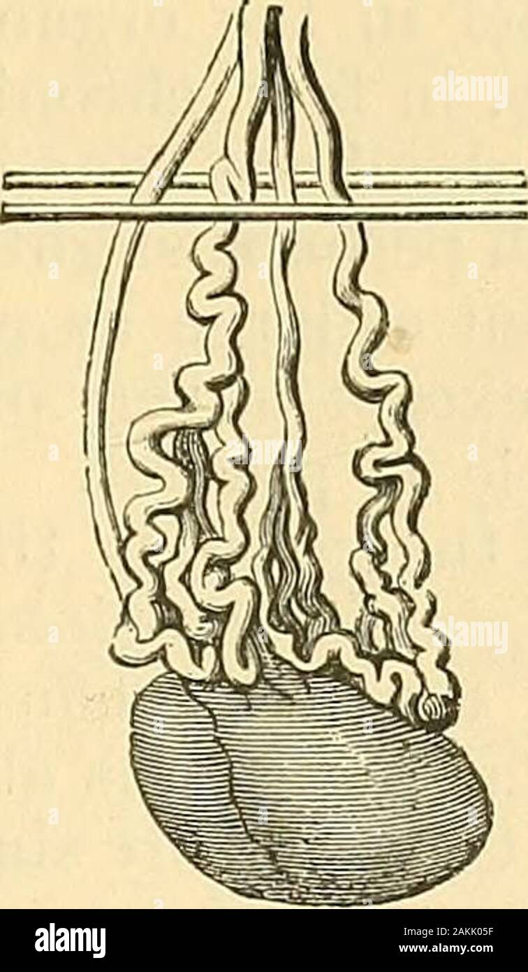 La scienza e la tecnica di chirurgia : essendo un trattato di ferite chirurgiche, malattie e operazioni . ^compressa tra il pinbehind e il loop di wirein anteriore (Fig. 846). Da thismeans lo scroto è quitefree e non compresso, andthere è alcun pericolo di ex-citando l'infiammazione o oede-ma. Piastrella del filo dovrebbe essere serrato di giorno in giorno come causesulceration nelle vene fino a quando non è completamente tagliato, che risultati di solito a circa una settimana o dieci giorni. Nel frattempo, vi è questione muchplastic buttato fuori circa le vene; questo infine contratti andobliterates loro canali. Questo metodo pr Foto Stock