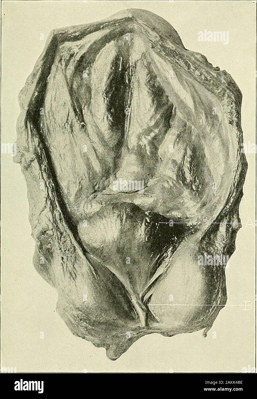 Un Americano di libro di testo dei genito-urinario malattie, sifilide e malattie della pelle . La prova dell' esistenza di ipertrofia.In questa fase il solo aumento della dimensione può essere di spessore, thelength e il diametro trasversale non essendo molto alterato. Ogni grado di allargamento è da notare, a partire da quella appena citata per le dimensioni di un pugno chiuso, un arancio o un cocoanut. L'ipertrofia possono essere generali, che interessano l'intero organo simmetricamente, o ci potrebbe essere un allargamento generale, nel quale tuttavia una porzione partecipa il 1 Am. Jour. Med. Sci., n.s., vol. c, 1890. Cambia in Foto Stock