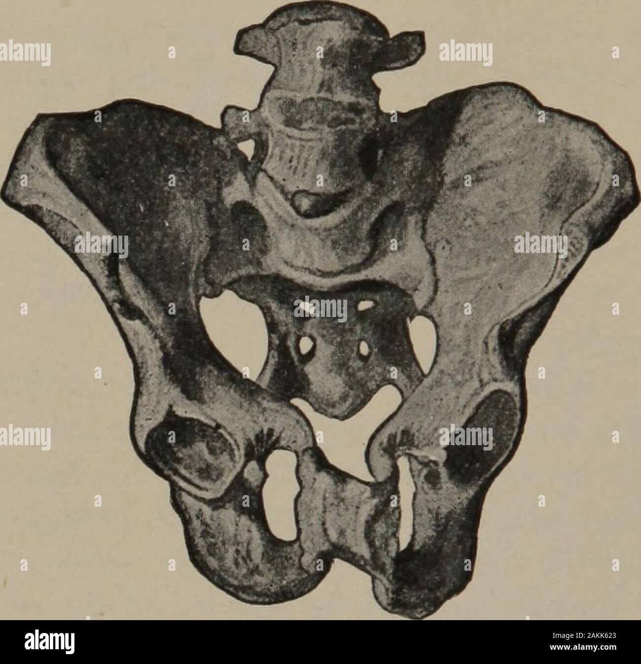 Un infermiere manuale di ostetricia . Fig. 3.-maschio e femmina del bacino. Un, Pelvi maschile-strette, pesante, compatta; B, femalepelvis-ampio, luminoso, capienti. Esso è stato progettato. Esso è poco profonda, ma molto capiente, più leggero in struc-ture e più liscia della pelvi maschile, che è profonda, conica,più ruvida per attacco muscolare, e più compatto. L intero problema in ostetricia consiste nella cassaforte passageof completamente sviluppato feto attraverso il bacino della madre.lievi contrazioni pelviche, risultante in noiose o instrumenta! 32 Un infermiere manuale di ostetricia. consegne, sono relativamente comuni, mentre un Foto Stock