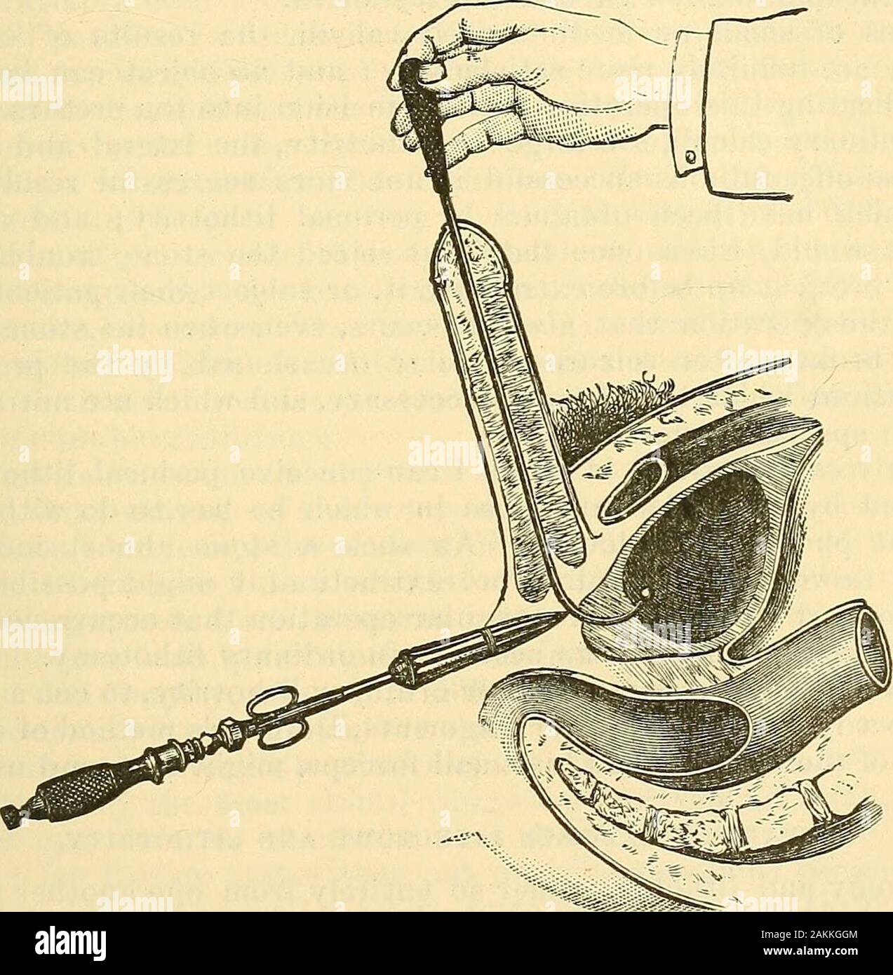 La scienza e la tecnica di chirurgia : essendo un trattato di ferite chirurgiche, malattie e operazioni . ^ Dolbeau ha ridotto a una operazione di formale, che egli ha descritto come^?Permeal Lithotrity^^ tliose procedure che sono state già intraprese?senza molto precise regole. Il funzionamento è estremamente semplice. Esso è costituito da quattro stadi:1. La realizzazione di una incisione nella linea mediana nella membranousportion del uretiira su un stafli scanalato; 2. il lento e graduale dila-tazione del collo della vescica per mezzo di un sei-bladed dilatatore;. Fig. 780.-perineale Lithoti-ità. Introduzione di Foto Stock