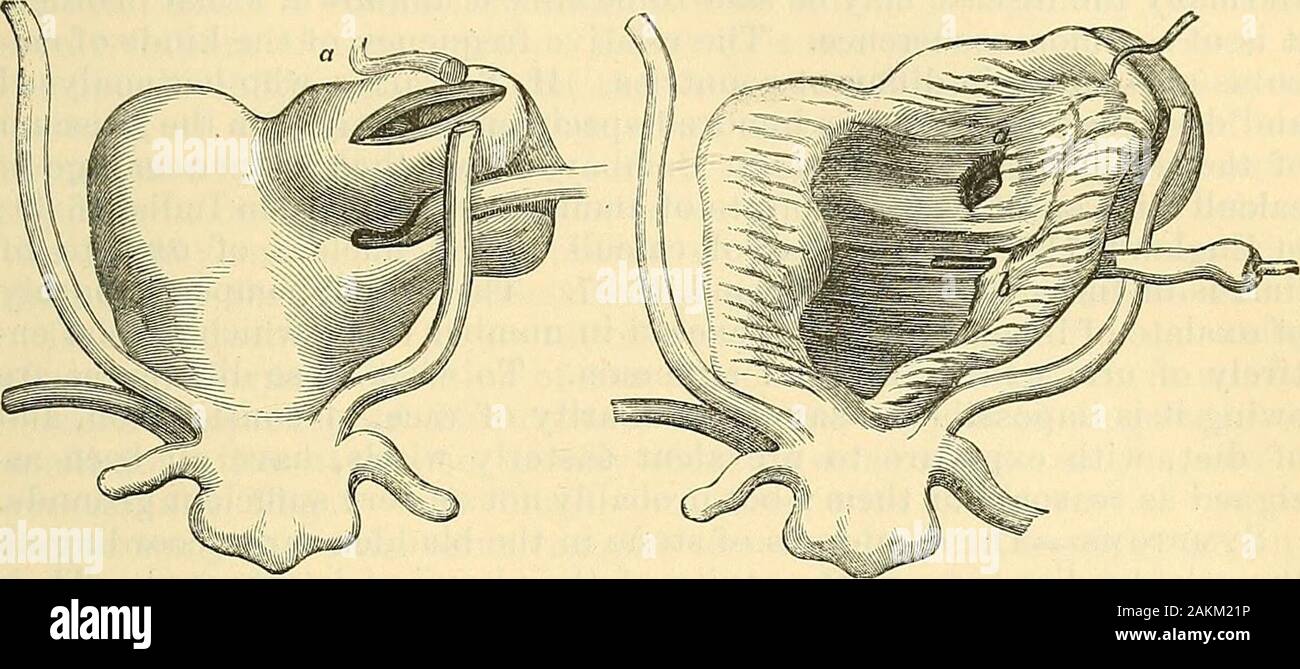 La scienza e la tecnica di chirurgia : essendo un trattato di ferite chirurgiche, malattie e operazioni . tipo, come un pezzo di brokencatheter, &c., è introiluced nella vescica, e costituirà il nucleo del tartaro ofa, rapidamente diventando incrostata da calculous, probabilmente phos- CAUSE DI PIETRA nella vescica. 729 phatic importa. Ma tlie cause di calcoli che avviene spontaneamente arevery oscuro. Non vi può essere dubbio,.it è vero che le diverse formsof concretezza sono collegati con le varietà di diatheses che havealready stata descritta ; e possiamo guardare alla formazione di un eal-. Fig. 722. Foto Stock