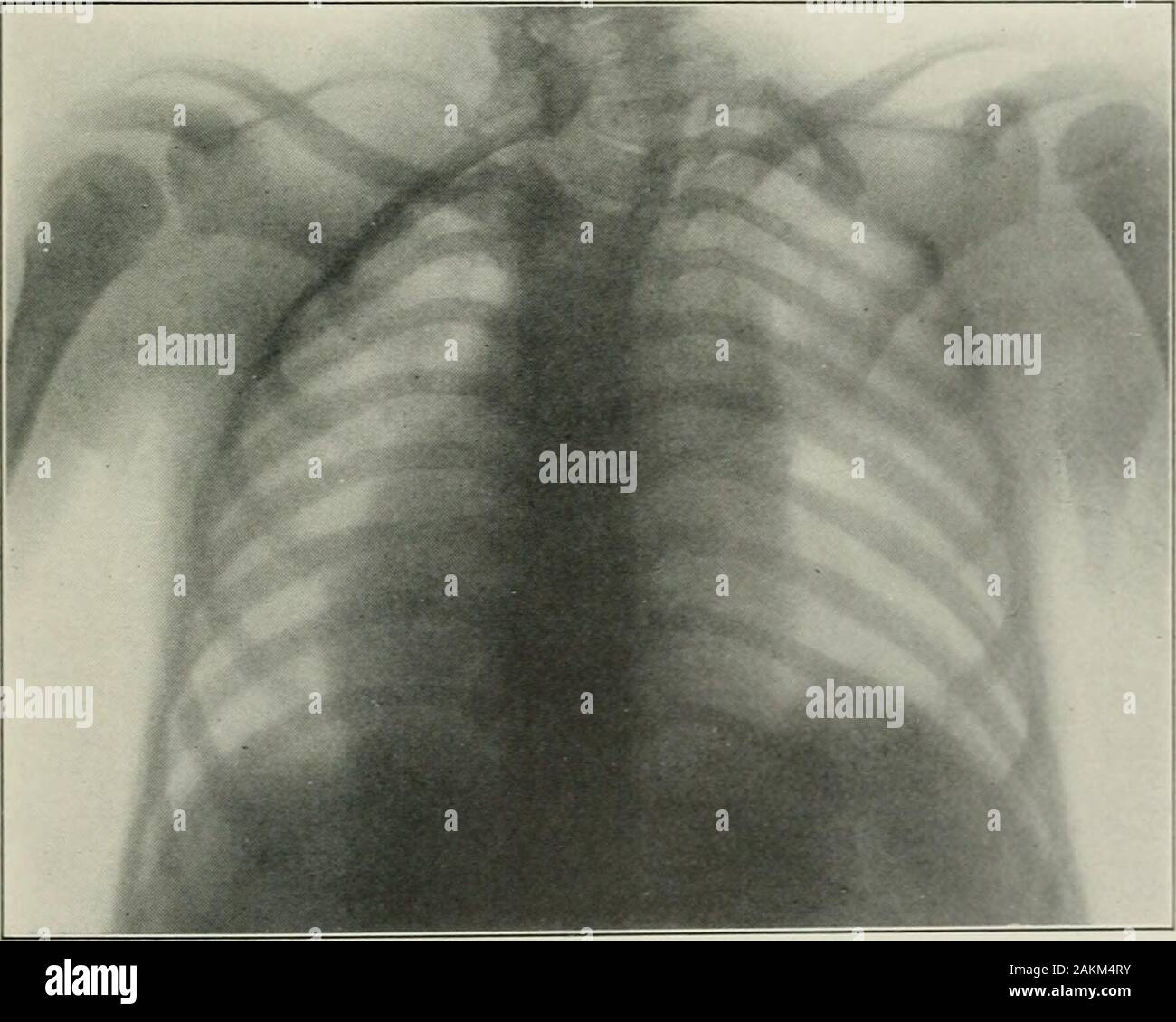 La prassi americana di Chirurgia : un sistema completo di scienza e arte della chirurgia . Fig. 26.5.-una malformazione congenita del VertebriP. Due a forma di cuneo e diversi malformedvertebra. ^contrassegnato curvatura laterale (torcicollo). Caso wa.s consigliata per il funzionamento, il futilitj- delle quali è sho-mi dai raggi x. (Originale). Fig. 266.-congenita di elevazione del ScapuL-p. Mostra la curvatura della colonna vertebrale, cuneo-shapedvertebrae, costola cervicale, e malformato scapola, entrambi elevati. (Originale). 682 la prassi americana di Chirurgia. Foto Stock