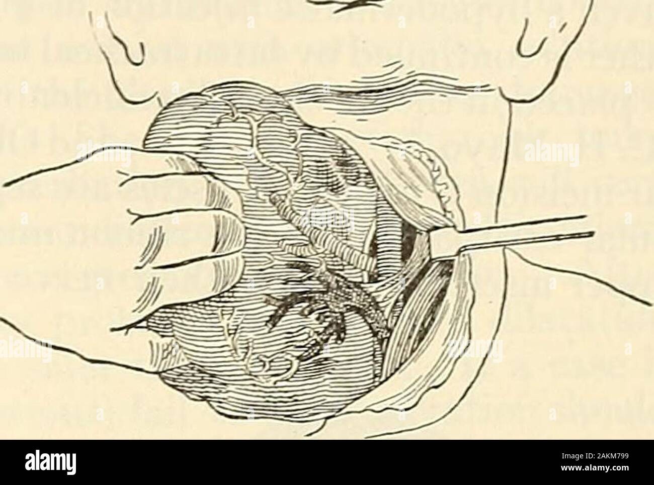 La moderna chirurgia generale e operativo . Fig. 809.-esposizione delle vene in corrispondenza di estremità inferiore beforeligation (Kocher). Fig. 8Gv.- -dislocazione del gozzo verso leviti (Kocher). dei muscoli in alto. La capsula del lobo è esposta ed è separatedfrom parti esterne (Figg. 808, 809, e 810). La porzione superiore di thegland viene cancellata. Il superior navi della tiroide sono trovati, legato con due liga-tures ciascuna e diided tra le legature (Fig. 811). La radura di thegland è portato su verso la mediana Hne e alcuni piuttosto grandi vene areencountered e legato (Fig. 813). La porzione inferiore del th Foto Stock