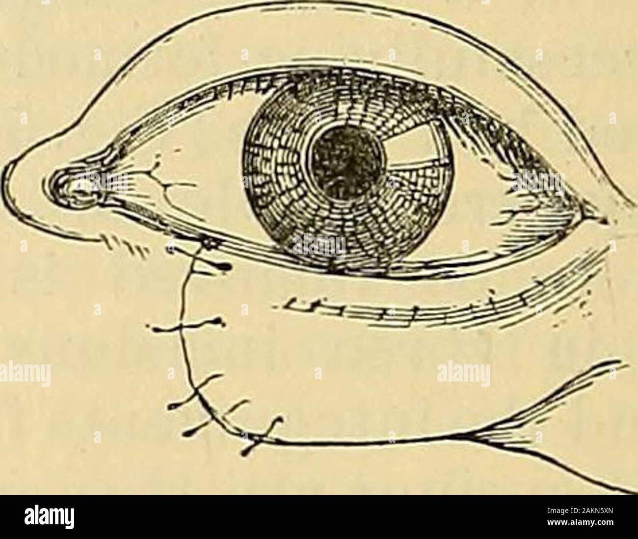 La scienza e la tecnica di chirurgia : essendo un trattato di ferite chirurgiche, malattie e operazioni . Fig. 591 -la palpebra inferiore deformato da Cicatrix. Fig. 592.-la palpebra inferiore dopo l'operazione. deformità apparente è stata lasciata. In un altro caso molto simile, in cui agirl era stato picchiato attraverso la palpebra inferiore con un cane, una simile opera-zione è stata praticata con risultati altrettanto buoni. In entrambi questi casi, theeyeball, che è stato ferito, era diventato atrophied, con opacità di thecornea. Ma quando un occhio artificiale è stata regolata per il globo shrunken,l'aspetto estetico del paziente è stata più che soddisfacente. L'operat Foto Stock