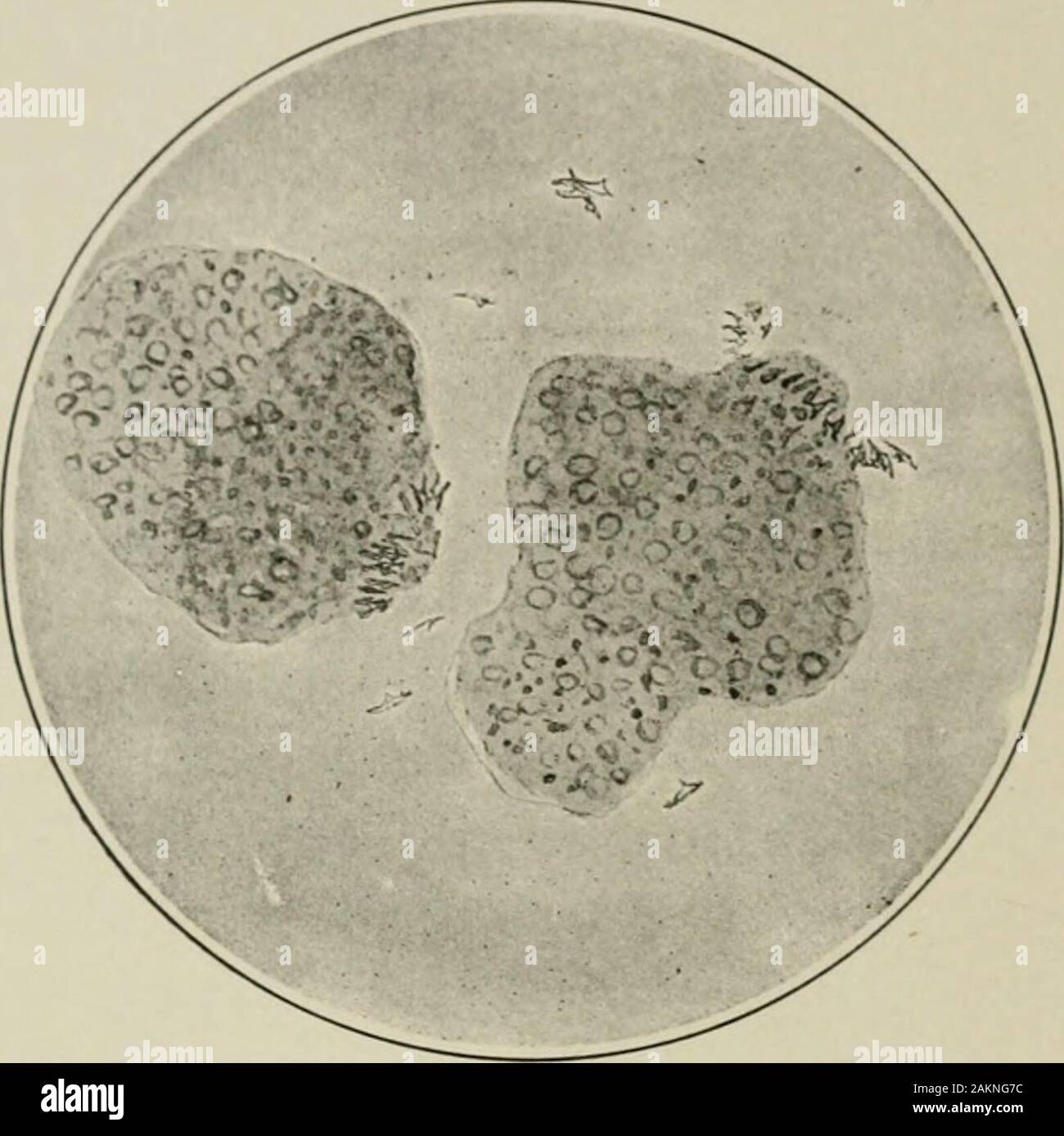 La prassi americana di Chirurgia : un sistema completo di scienza e arte della chirurgia . tratto, le cellule del sangue, fibrina, leucociti, e pus sono presenti ad una maggiore o minore de-gree, e spesso sono indicativi del personaggio, la misura e la posizione della messa a fuoco. Fir.. 143.-Echinococco. Gli embrioni e gli opuscoli scaricata in .sputo da un caso di hydatidcy."t della hmg. da cui derivano. Pus, talvolta miscelati con cellule epatiche possono essere dis-caricato attraverso il muco dal fegato di un ascesso, che non burstsinto unconmionly polmone; nello stesso modo echinococcus opuscoli, noduli di actinomy-cotic Foto Stock