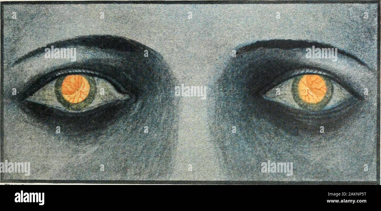 Le transazioni . ar transparentlens. È stato premuto in avanti mentre la pressione corrispondente wasmade con una spatola avvisatore acustico nella parte superiore ed esterna del limbus thecornea, e con una leggera trazione verso il basso, la holding suspen-legamento sory sopra ha dato modo e la lente è stata consegnata withoutaccident. Una massa coerente di umor vitreo presentati alla SEC corneale-zione, ma come la sutura è stato tirato lentamente home si ritira andwith esso leggermente prolapsed iris, lasciando un tondo centrale pupilla. La convalescenza è stata senza incidenti. La sutura è stata removedon il terzo giorno. Al termine della prima settimana l'occhio wasalmost wh Foto Stock