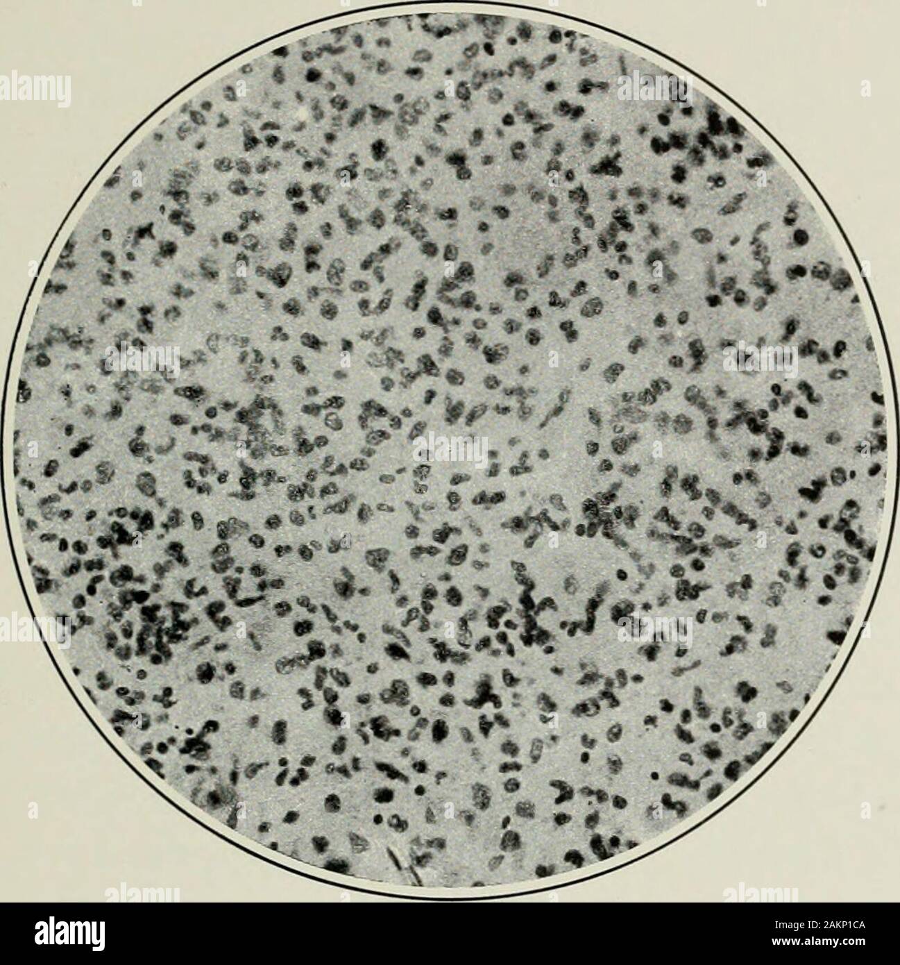 La prassi americana di Chirurgia : un sistema completo di scienza e arte della chirurgia . es. In alcuni dei più primitiva animali, come il amphioxus,la su])porting dello stroma è composto interamente da cellule ependimali, ma superiore nella scala troviamo che la parte principale è preso da cellule stellate (astrociti). In tumori e la formazione di tumori. .Ijfo tlie caso di niainnials è Ix^liovcd da sonio che t]U&GT; astrociti non sono deriveddirectly dalle cellule ependimali, Init da forme intermedie che possono betermed astroblasts. Tutti glia cellule, se provvisto di lunga o breve processi,bru Foto Stock