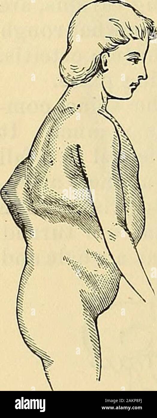 La scienza e la tecnica di chirurgia : essendo un trattato di ferite chirurgiche, malattie e operazioni . della sua handsor gomiti, ed egli non è in grado di sterzare bruscamente e improvvisamente oltre sulla sua faccia.occasionalmente incipiente della curvatura, quando si verifica, assume più ofa quella laterale di una direzione angolare ; e in un caso fatale ho seenthe effettivamente dorso piegato all'indietro, in modo da essere incurvata presso la sede ofdisease. In alcuni rari casi, il vero excurvation angolare dependenton carie dei corpi dei vertebrtfi può essere associato con l'ordi-nary curva laterale di debolezza. Gli arti inferiori ora diventare debole Foto Stock