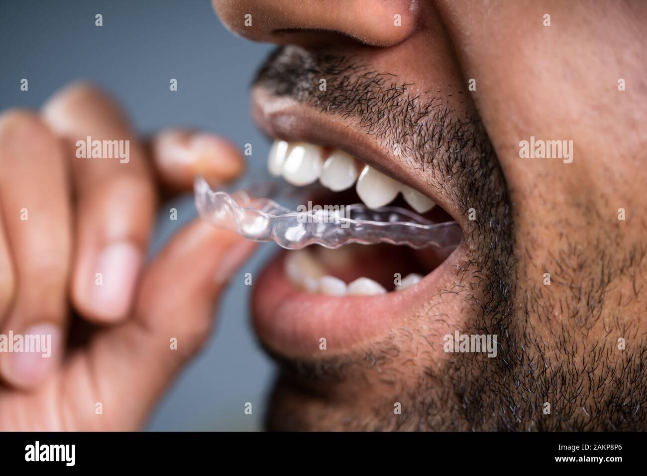 Close-up di una mano di un uomo mettendo allineatore trasparente in denti Foto Stock