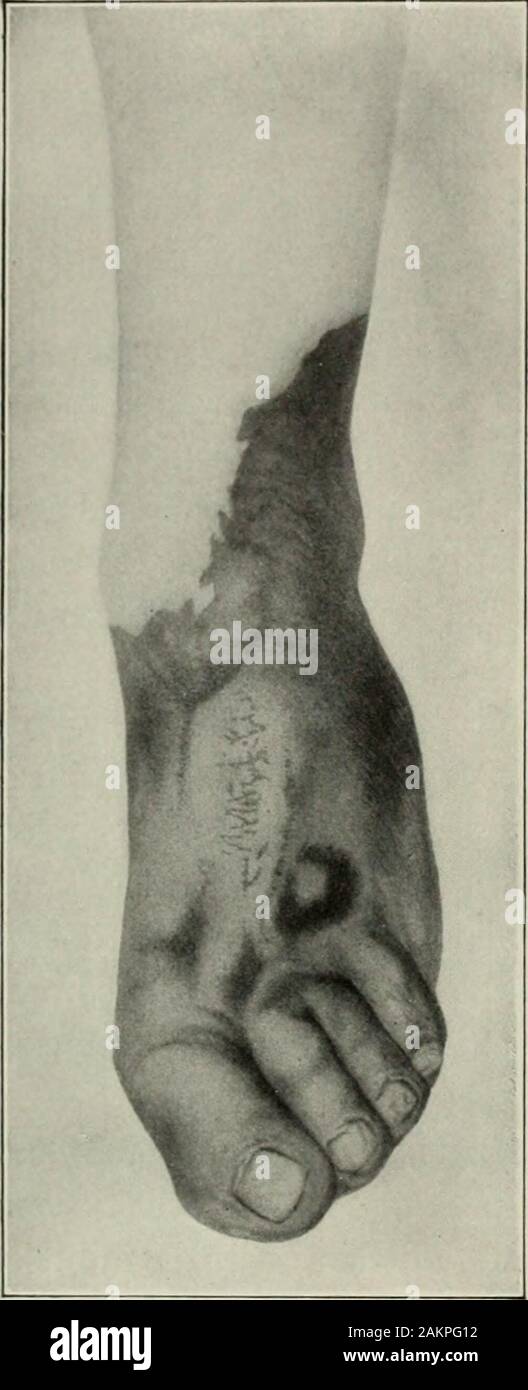 Cancrena Secca Immagini E Fotos Stock Alamy