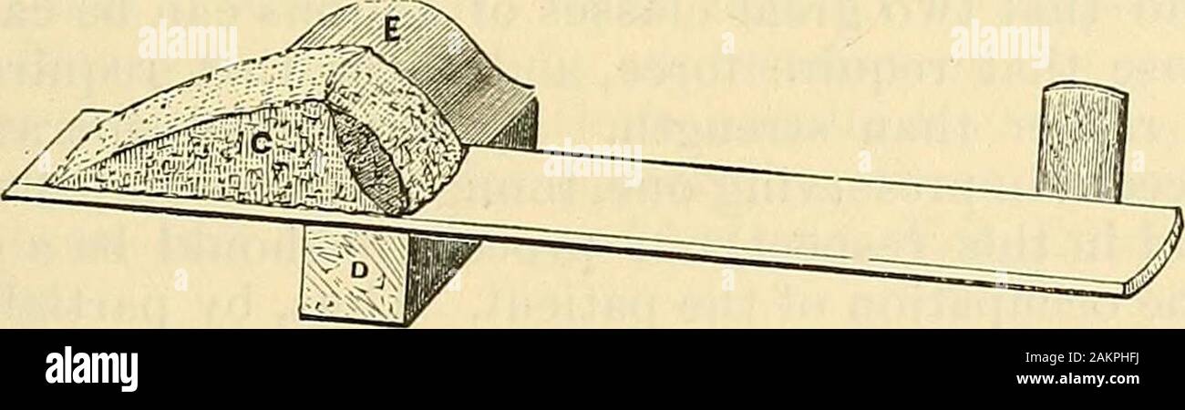 La scienza e la tecnica di chirurgia : essendo un trattato di ferite chirurgiche, malattie e operazioni . mezzi di una India-gomma tubeto drenaggio consentono la libera uscita di scarico. Piastrella mano viene ad essere collocato su una laminetta.La più conveniente è un semplice di legno siDlint, con un ad angolo ottuso. Fig. 4.54.-Listers stecca con il supporto di sughero per mano. Foto Stock