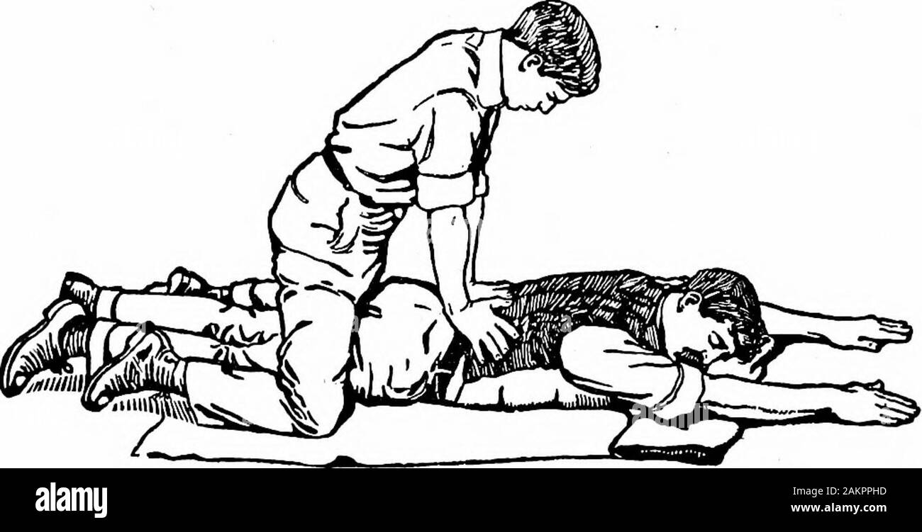 Incidenti ed emergenze; un manuale del trattamento degli strumenti chirurgici e le emergenze mediche in assenza di un medico . Fig. 3.--Ttiird passo per la respirazione artificiale. ponendo il paziente prona, witli il con il lato stampato rivolto verso il basso e i bracci ex-tendevano sopra la testa. L'helper mette se stesso lungo il lato del sofferente, inginocchiati su un lato o a cavallo del paziente,mentre egli pone le mani sopra i lombi, palmi delle mani giù andfingers esteso verso la testa del paziente. Egli thenbends avanti, premendo delicatamente ma con fermezza moderata uponthe lombi del paziente, comprimendo il torace e addome,per abou Foto Stock
