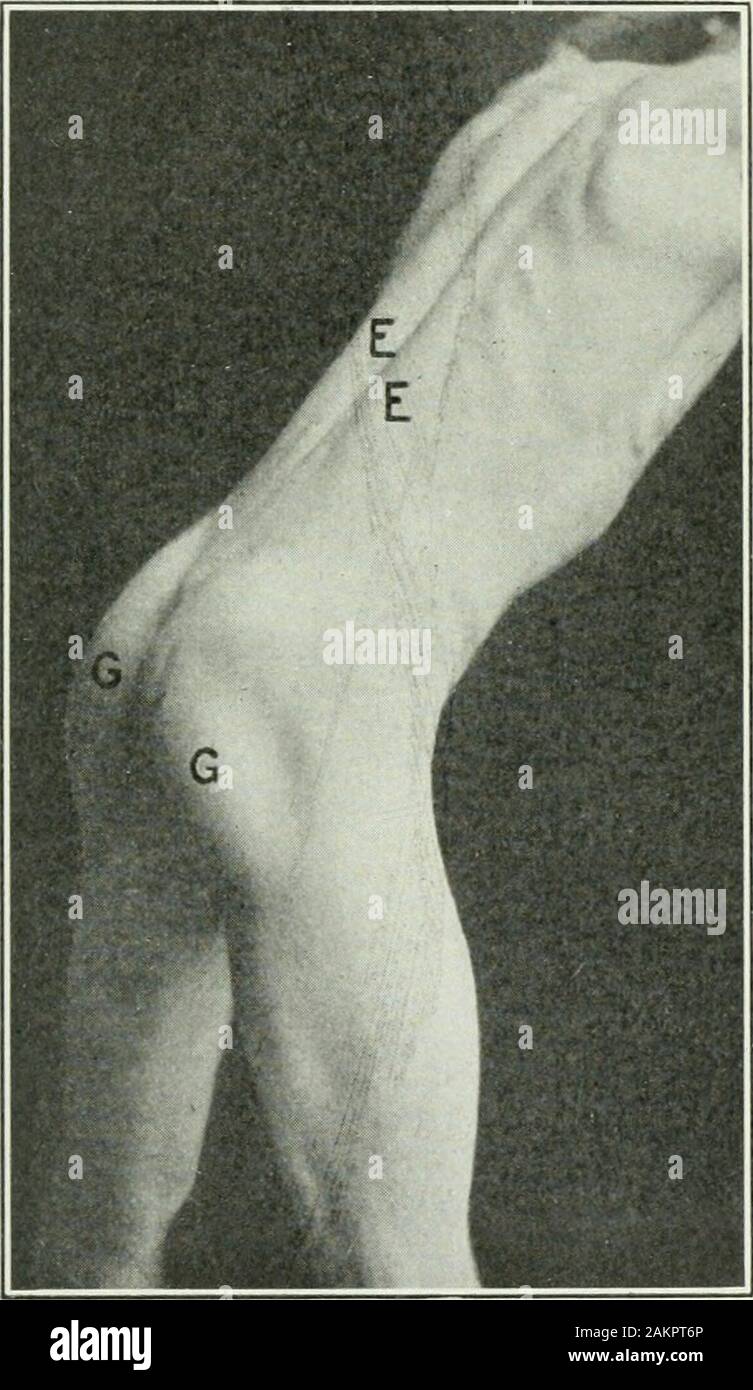Applicata anatomia e kinesiologia; il meccanismo di movimento muscolare . erettore sul lato del sollevato footthat atti e che si rilassa quando il peso è posto su quel piede. 216 MOVIMENTI DELLA COLONNA VERTEBRALE OBLIQUE DI EXTENSORS. pie™ frthe^tf i muscoli kno.-n come chirurgicamente la com-plesso nella regione del collo il semispinals, estendentisi lhM A1 mt; Fig. 127.-l'erettore spinse.(Gerrish.) Fig. 128.-l'extensors obliquo.(Gerrish.) bpn.il)? tK Pf ^^ ^ ?•°**°^ zona toracica Thev 1 e QUADRATUS LUMBORUM 217 ORIGINE.-i processi trasversali del vertebnie. Inserimento.-apofisi Foto Stock