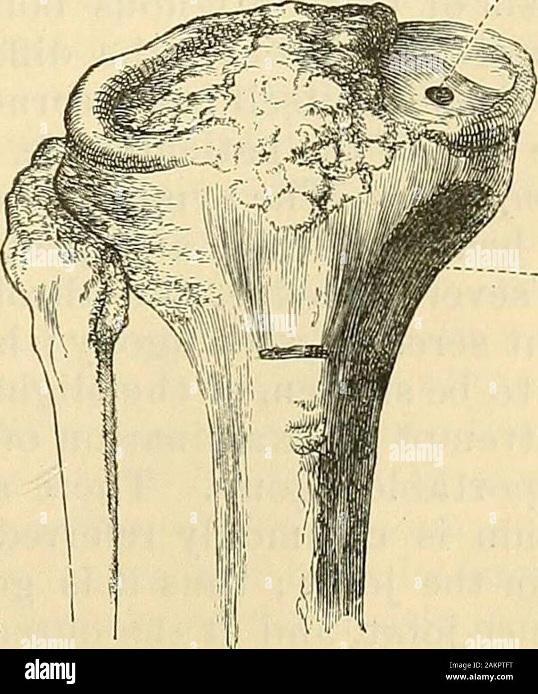 La scienza e la tecnica di chirurgia : essendo un trattato di ferite chirurgiche, malattie e operazioni . suppurazione, whichgives luogo alla carie e necrosi limitata(Fig. 436 a); come l'azione malato ap-proaches la superficie articolare, la cartilagine che incrosta diventa loosenedand staccate e allo stesso timegradually si disintegra e becomesperlbrated (Fig. 486 6), nutrizione in itbeing arrestati o modificati mediante il mor-bid membro dell'osso sottostante. Whenonce la cartilagine diventa influenzata, thewhole della parte interna del giunto di velocità ily suppurates, e viene distrutto. Inother casi, infiammatoria Foto Stock