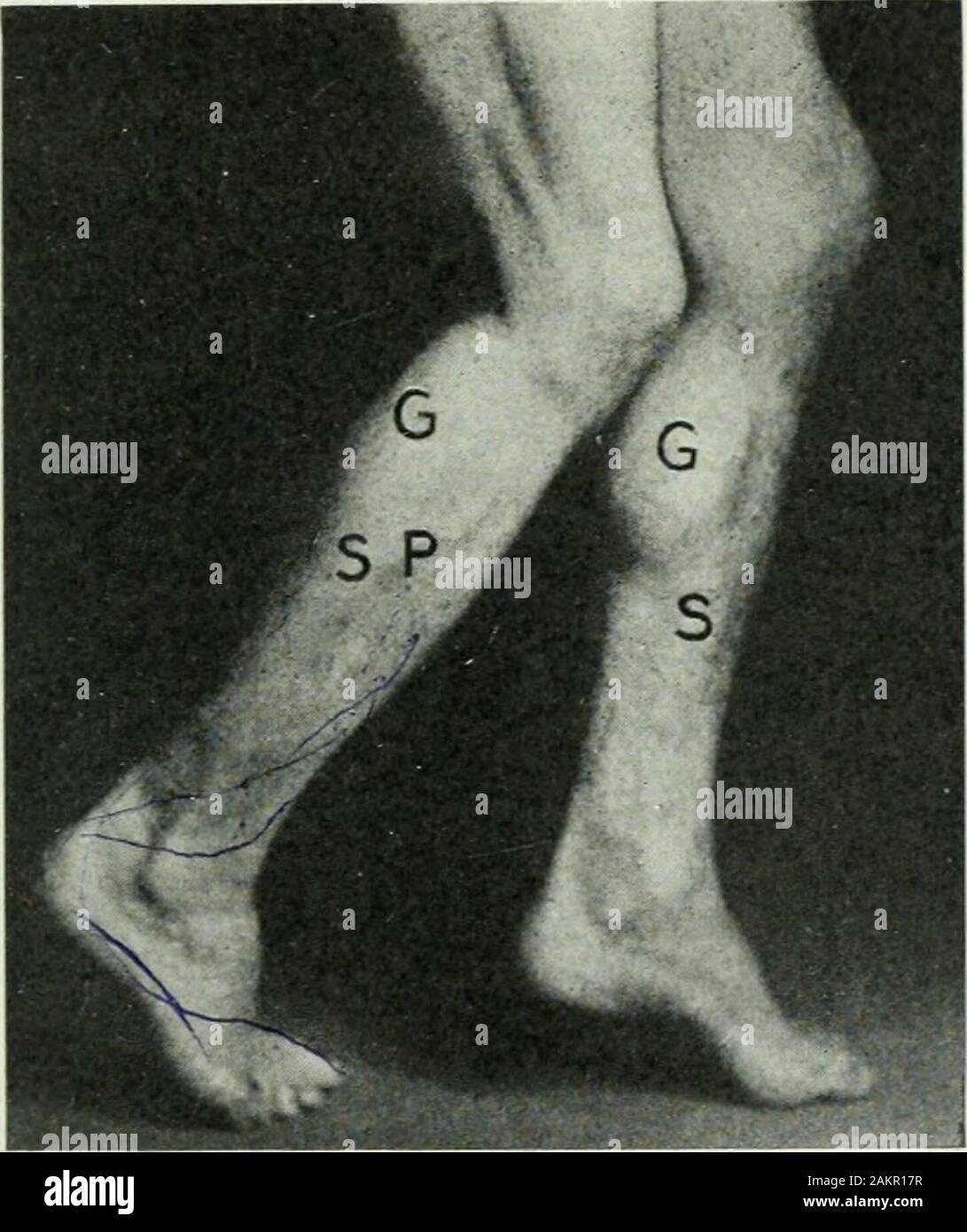 Applicata anatomia e kinesiologia; il meccanismo di movimento muscolare . les neededto sollevare una persona di peso noto può essere calcolata assumendo itto da una leva o di classe, ma se noi lo chiamiamo seconda classe abbiamo mustadd nella reazione di tirare e questo comporta una geometricalseries. PERONEUS LONGUS. Questo muscolo è notevole per la sua grande potenza in proporzione allasua dimensioni e per il lungo e tortuoso corso del suo tendine del inserisci- PERONEUS LONGUS 195 zione. È situato lungo la fibula sul lato esterno della gamba,appena al di sotto della pelle. Origine.-La tuberosità esterna della tibia e la tomaia tw Foto Stock