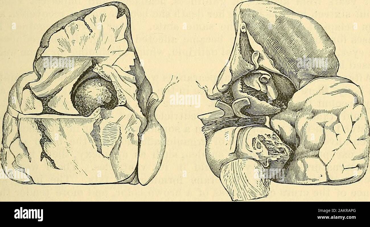 La scienza e la tecnica di chirurgia : essendo un trattato di ferite chirurgiche, malattie e operazioni . grandi come piccioni Ggg^ contenente un disco irregularvery asciugare il coagulo di sangue si era trovato premendo sul pons Varolii.La sac aveva dato il via a un certo punto, lo stravaso che avvengono in thesubstance del Pons, che è stata addolcita, e di un colore bluastro. 2. Le più frequenti modalità in cui la morte avviene in questi casesis dal sttdden la rottura della sacca e lo stravaso di sangue nel thecavity del arachnoid e le maglie della pia mater alla base del cervello, o nell'ventri laterale Foto Stock