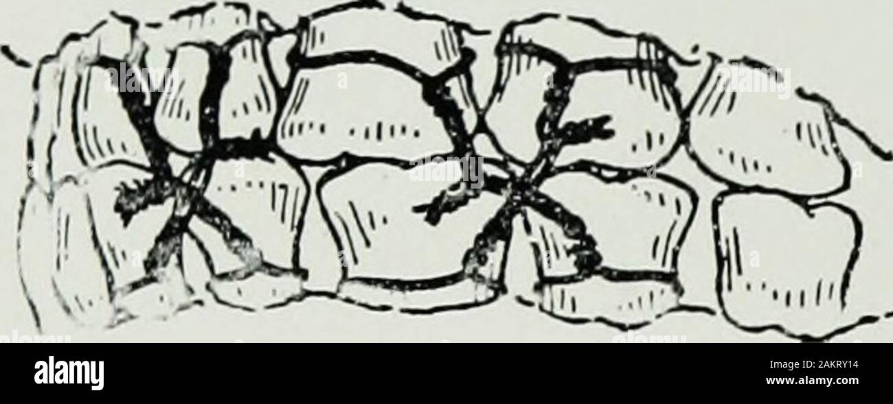 Chirurgia di guerra del faceA trattato sul restauro in plastica dopo lesioni facciali da John BRoberts ..preparato su suggerimento della sottosezione in plastica e chirurgia orale collegati con l'ufficio del chirurgo generalIllustrated con 256 figure . nt i mezzi di mantenimento di immobilità.In tutte le forme di laminette maggiore immobilità sarà di norma ob- 212 chirurgia di guerra del viso. tained da bendaggio ganasce insieme. Se desiderabile, guttaperca i cunei possono essere posizionati tra le ganasce su ogni lato della bocca in modo da avere uno spazio in mezzo per introductionof cibo. Una forma grezza di interdentale sp Foto Stock