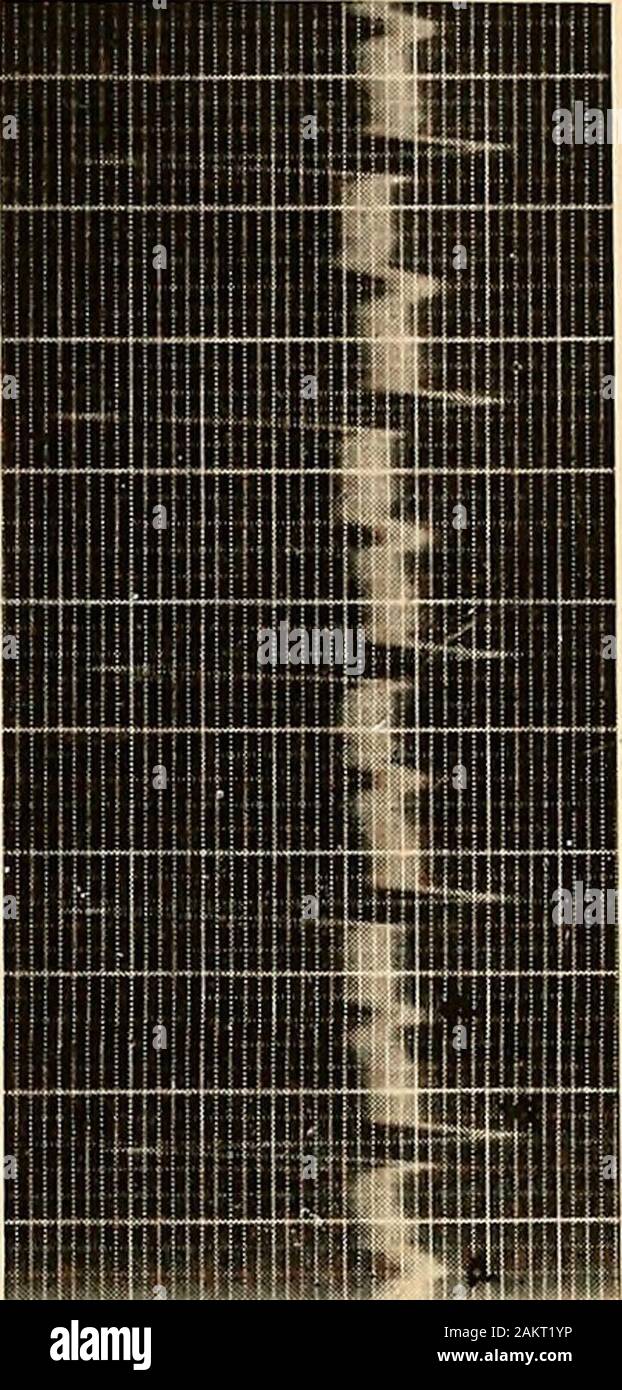 Elettrocardiografia clinica . l complesso attacco dopoil, mostrando che oscurantismo non si è verificato. Theindividual onde di questi elettrocardiogrammi sono inalterate. ,^!;*^/l •^-..: . -.,. , La fig. 48.-parossistica tachicardia sinusale. Velocità da 55 a 136. Elettrocardiogramma in derivazione II. La figura 47 rappresenta questo disordine e la Fig. 48, il termina-zione di un parossismo. Parossistica tachicardia auricolare in presenza di tachicardia auricolare il focus ectopico stimolo del processo di produ-zione è in qualche punto nella muscolatura auricolare. Ogni auricolare X ^muuu Fig. 49.-Schema grafico di auricolare parossistica tachicardia. battere i Foto Stock