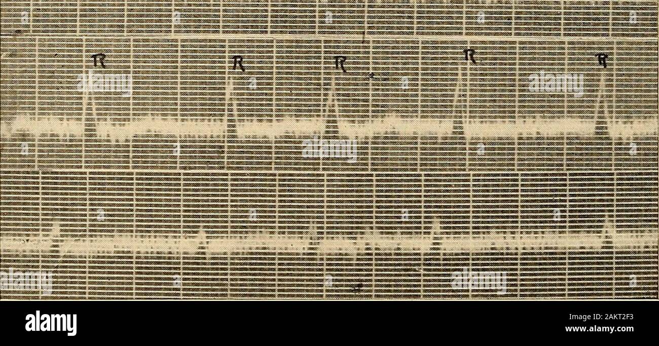 Elettrocardiografia clinica . Fig. 41.-Coarse fibrillazione auricolare. Le derivazioni I, II, e III. ff, fibrillare. Piccole ondine irregolari sono spesso distinguibili, variare in velocità,ampiezza, e contorno; essi rappresentano il fibrillare twitchingsof auricolare muscolatura. Essi sono indicati con f di elettro-cardiograms. 7° elettrocardiografia clinica Hewlett e Wilson raggruppati i loro elettrocardiogrammi di auricu-fibrillazione lar secondo il carattere del fibrillare wavelets |i|i|Mi|i|I||i|m||iiTiT|HH|l|I||iiii|iHi|li||lHiii,il|i;il|li|ili|i|r|ri|| X 1-v v fig. 42.-Schema grafico di f Foto Stock