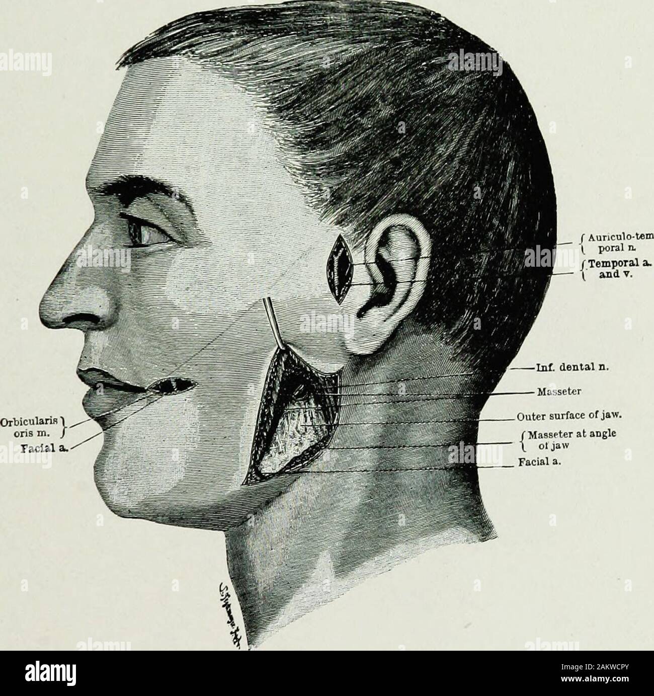 Chirurgia di guerra del faceA trattato sul restauro in plastica dopo lesioni facciali da John BRoberts ..preparato su suggerimento della sottosezione in plastica e chirurgia orale collegati con l'ufficio del chirurgo generalIllustrated con 256 figure . l arteria di nervo thyro-hyoid interna del muscolo nervo laringeo Thyro-hyoid preminenza della muscolatura della laringe Thyro-muscolo hyoid Superior arteria tiroide esterna del nervo laringeo omo-hyoid muscolo Sterno-hyoid muscolo anteriore vena giugulare Fig. 24.- La dissezione del lato del collo con bordo di sterno-mastoide (ritratta da Beesly e Johnston.) Il maxil interna Foto Stock