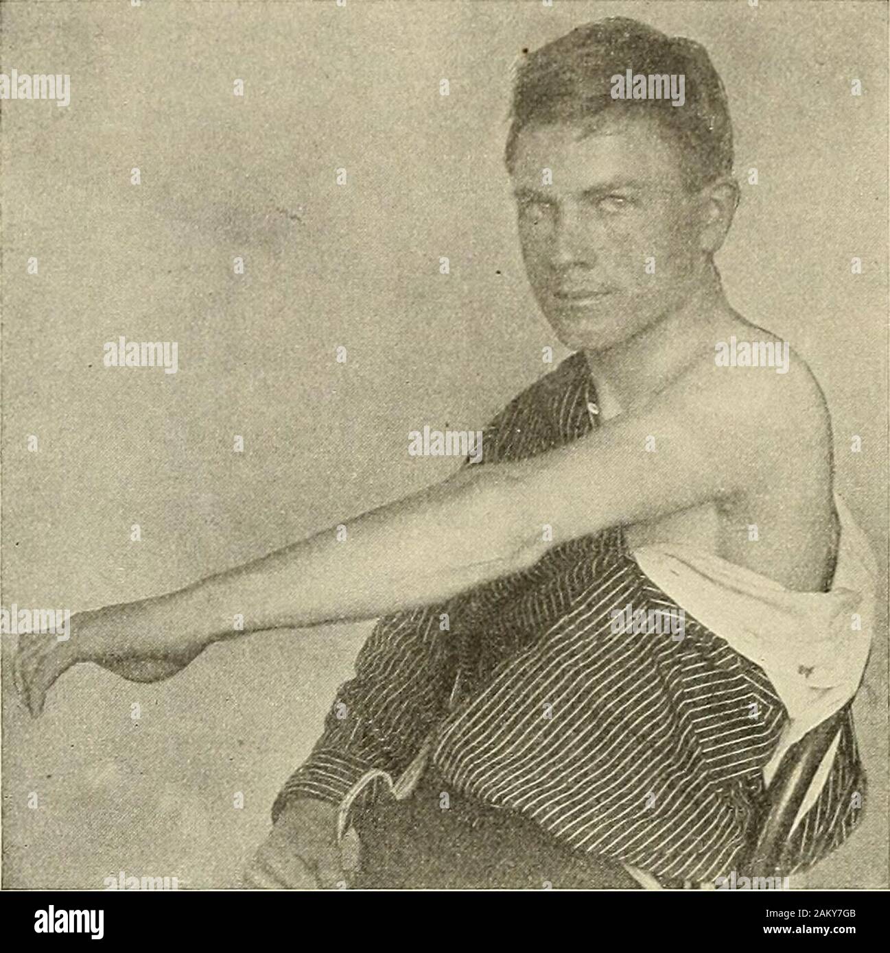 La moderna chirurgia generale e operativo . Fig. 314.-frattura tra il condylestreated dalla posizione di Joness. Grado di volun-tar&GT; la flessione ottenuta. ;68 malattie e lesioni delle ossa e articolazioni di fratture olecranon processo della uhia verificarsi non uncommonlyin adulti. Hulke afferma che una tale frattura non avviene mai prima dell'età offifteen, ma lo scrittore ha visto in Jefferson Medical College Hospital agirl di età compresa tra i quattordici con un olecranon fratturato. La causa è diretto violenceor azione muscolare. Solo un piccolo frammento può essere strappata o l'intero. Fig- 315--frattura tra il co Foto Stock