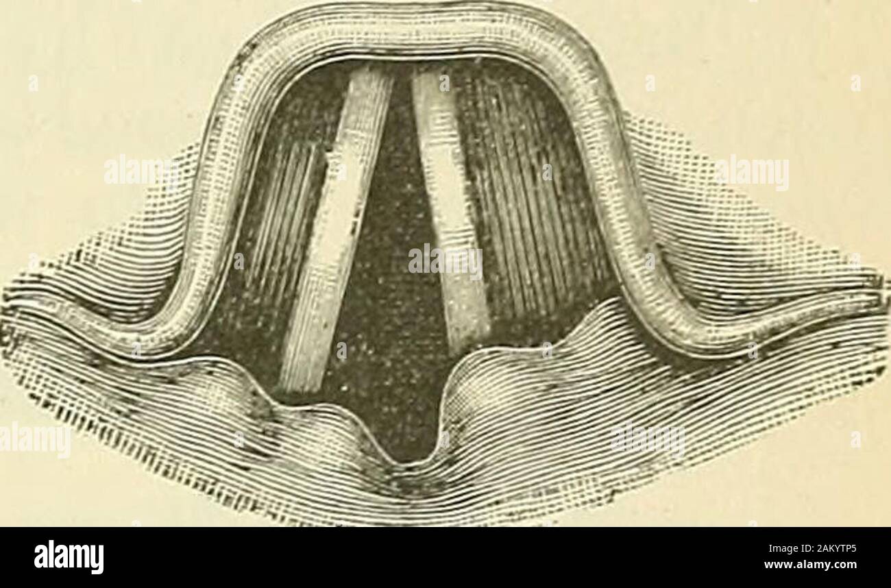 Lehrbuch der klinischen Untersuchungs-Methoden : für Studirende und praktische Aerzte . Fig. 194. Arytänoideuslähmung. Lähmung derMm. interarytaenoidei transversi und obliqni(Schliesser der glottide respiratoria) bei Laryn-gitis. Stellung der Stimmbänder bei der Pho-nazione Offenbleiben mit der glottide respira-toria. (Nach v. Ziemssen.). Fig. 195. Recurrenslähmung. Cadaver-stellung deslinken Stimnibandes (in der Mitte zwischenAdduction und rapimento bei completerLähmung des M. laryngeus recurrens peccato.Inspirationsstellung des rechten Stimm-bandes. (Nach V. Ziem ssen.1 W^ Foto Stock