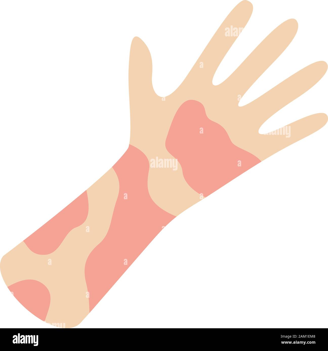 Allergic contact dermatitis Immagini Vettoriali Stock - Alamy