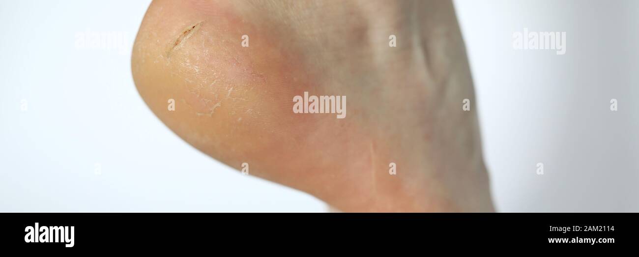 Dolorose lacerazioni della pelle a piedi Foto Stock
