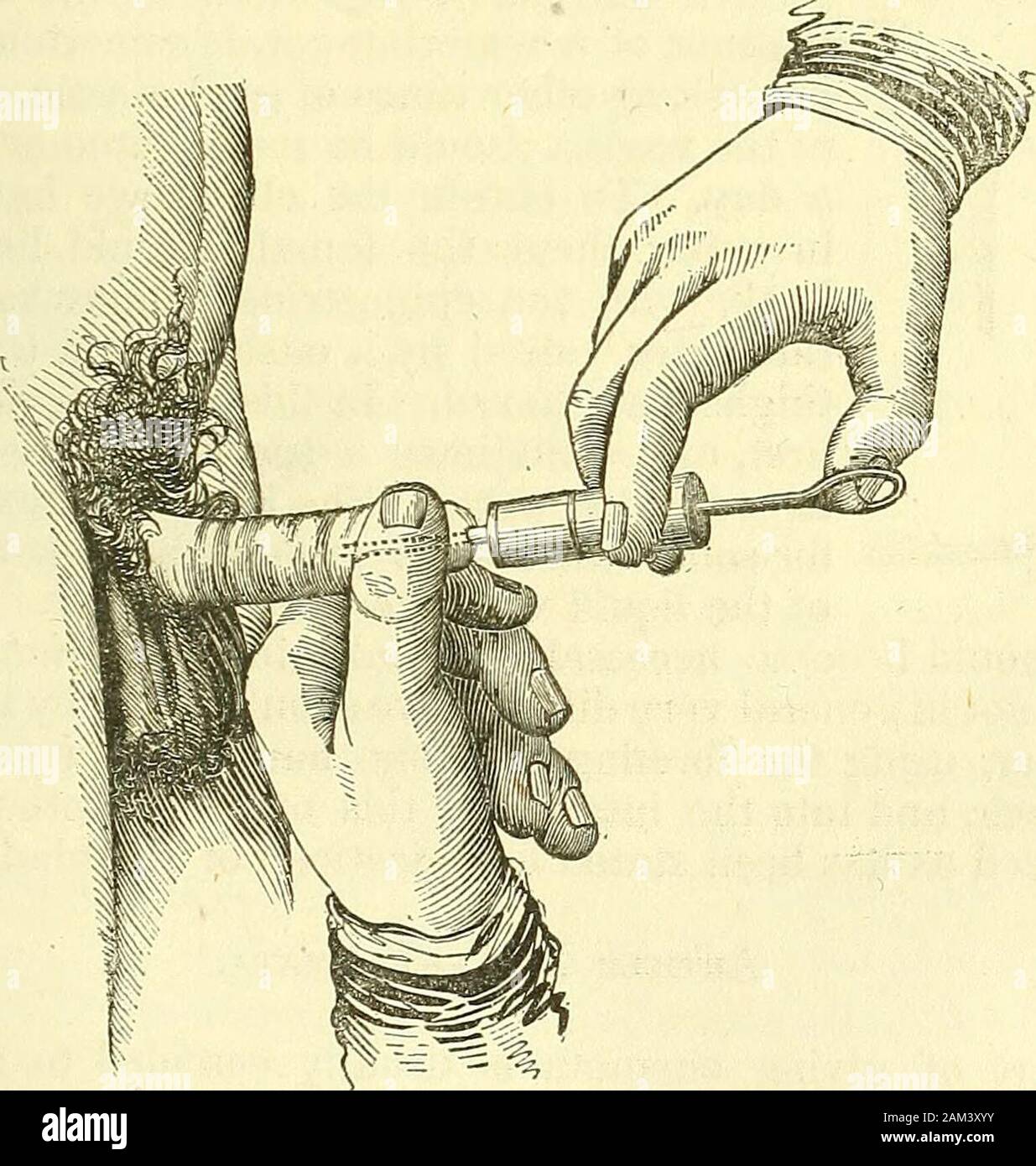 Nuovi elementi di intervento chirurgico . Canta. 223 per iniettare tra i coperchi e occhio, è meglio utilizzare una ^^s- ^?&GT;piccolo sifone siringa, leggermente conica, come theurethral siringa, (Fig. 139.) per il naso e la bocca, ifwe*v.ish di iniettare abbondantemente, abbiamo bisogno, talvolta, ofa sjTinge di maggiori dimensioni. La stessa osservazione si applica fo ab-scesses e fistulous passaggi in tutte le regioni di thebody. Se la cavità di essere lavato è molto la.RWI, abbiamo haverecourse per un clistere siringa. Iniezioni di l'uretra sono realizzati con siringhe a containabout un oncia di liquido, (Fig. 140 ;))))) il sifone portio Foto Stock