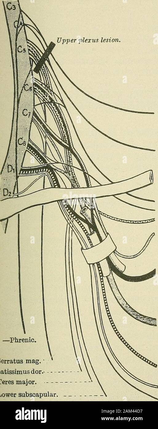 Terapia medico-chirurgica . Caso IV âRifle bullet avvolto : punto di entrata, sotto tlie leftclavicle nella parete anteriore dell'ascella; i)oint di uscita, quattro fingersbreadths dal bordo dorsale della scapola, circa 5 cm. da itsinferior angolo. Ferita penetrante del torace. Immediata e totale paralisi del braccio ; emorragia copiosa fromwound con emorragia secondaria. A un esame di un anno dopo la lesione: vi è una paralisi della thesupinator longus, extensors radiale, extensors delle dita e il pollice,e abductor pollicis longus. La paralisi di hypothenar musclesand interossei. Vista parziale ])aralvsis Foto Stock