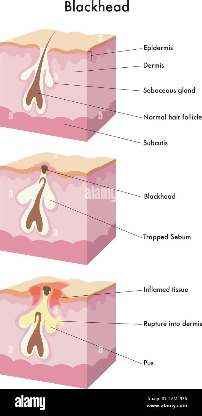 Illustrazione medica della formazione di blackhead. Illustrazione Vettoriale