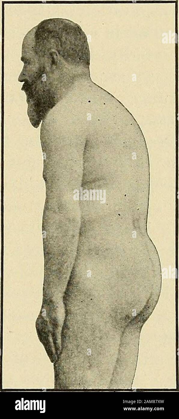Malattie nervose organiche e funzionali; un testo-libro di neurologia. Posizione assunta dal paziente juiFerlngdalla paralisi agitans. Rigidità della schiena in sisagitani paralizzati. Nonostante la rigidità, i muscoli rimangono in buone condizioni, enon atrofia o mostrare alcun cambiamento elettrico. Nell'ultimo stadio l'anatrofia da disuso è abbastanza comune. In 188 casi i riflessi profondi erano normali in 90, erano esagerati in 68, e sono stati diminuiti in38. Le scosse del ginocchio erano spesso disuguali sui due lati, ma questa relazione eghno al tremore. Le contrazioni delle mani e dei piedi si sviluppano occasionalmente nelle laterfasi Foto Stock