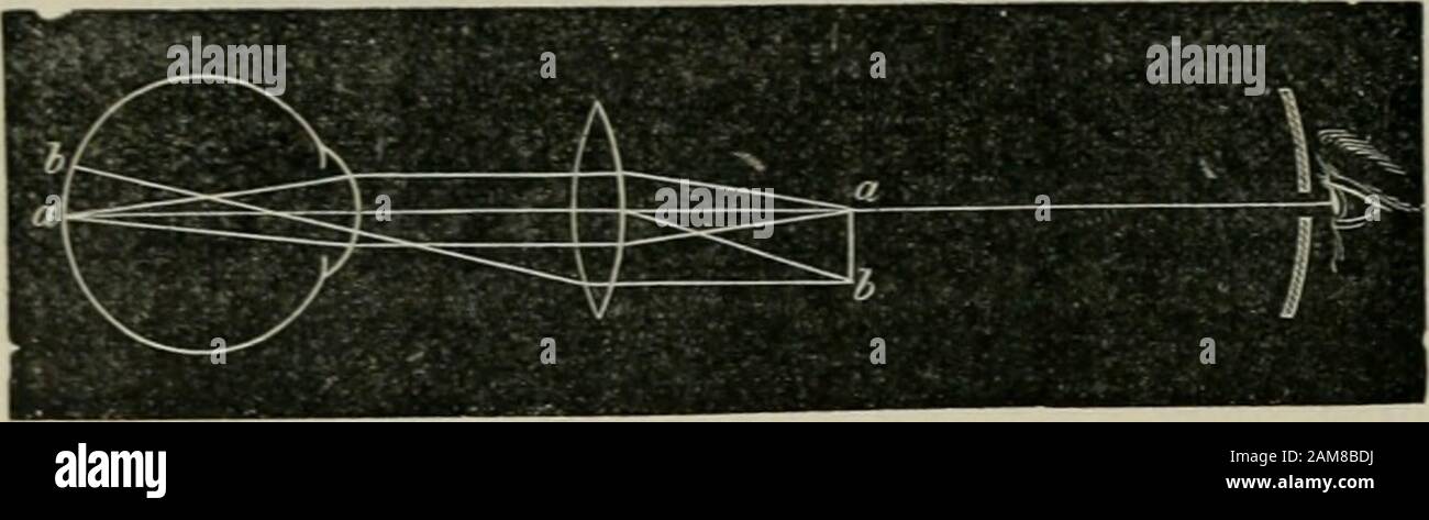 Traité de chirurgie . Fig. -2l&gt;. E.vaincn du fond de lœil avec roplitalinoscope siiiijlc à main. 18 DE LEXAMEN DE LŒIL.. Fig. ^l. Fornialion de limage ophtalmoscopique renversée. Lorsque rapparilion do la coloration rouge unique dans tout le choppupillaire lui un permis de reconnaître cjue les rayons lumineux parviennent bienjuscpià la rétine et quaucune opacité nexiste dans les milieux de Tœil, lobser-vateur prend de la main gauche une lentille convexe de 16 à !dioptries. Cettelentille est ordinairement enchâssée dans un cercle de buffle pourvu dun petitanneau quon tient entre le Foto Stock