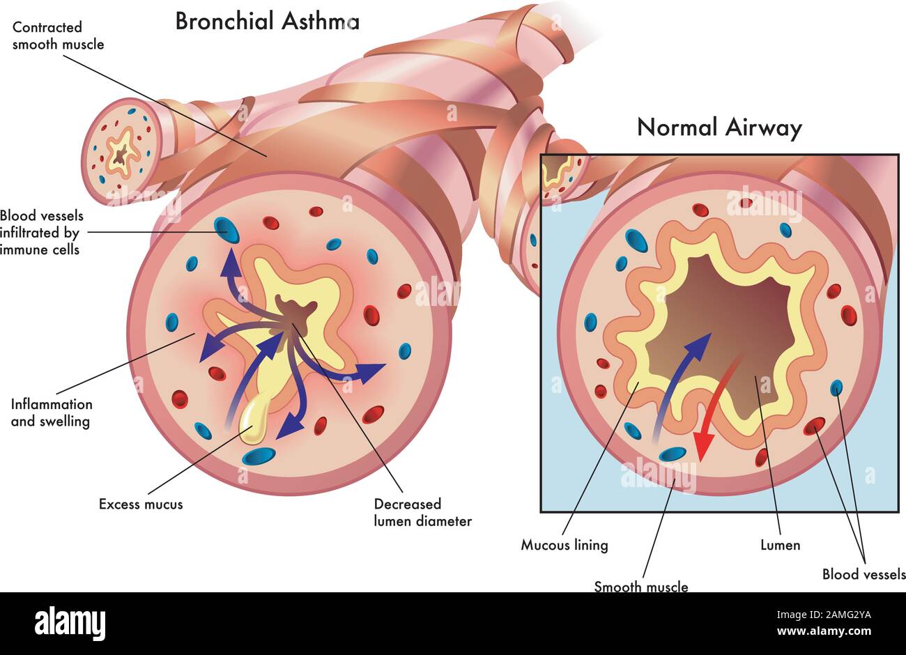Illustrazione medica degli effetti dell'asma bronchiale. Illustrazione Vettoriale