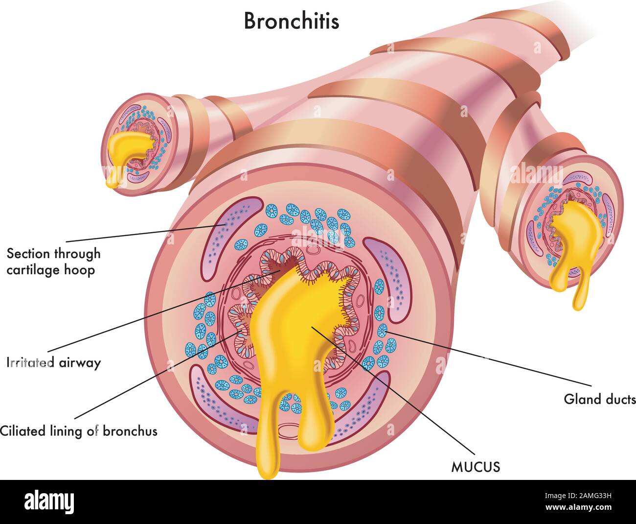 Illustrazione medica degli effetti della bronchite. Illustrazione Vettoriale