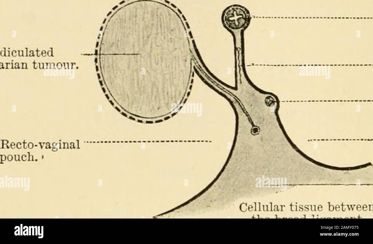 Atlante ed epitome di ginecologia. L epoch e quando la tensione  intra-addomi-nale è aumentata. Sterilità, dalla solita combi-nazione con  ooforite. Febbre (in gonorrea, solo post-sforzo o eccitazione). Prognosi -  la concezione