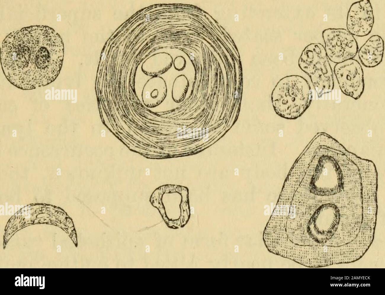 Manuale di anatomia patologica. S areolartissue essendo convertito in crescita morbosa, la papillse superipertrofica, così come l'epitelio che riposa su di essi. Il teepitelio si trova anche immergendosi nelle parti profonde e filtrando il tessuto connettivo CO-sottocutaneo così come gli strati più profondi della pelle. Nell'ultimo campione che abbiamo esaminato, che era dal labbro inferiore, una sezione verticale mostrava uno strato biancastro esterno, circa un terzo pollice di spessore, marcato strie byvertical, e poggiante su un certo tessuto areolare, grasso, andmuscle. La sua superficie mostrava però lievi tracce di suddivisione Foto Stock