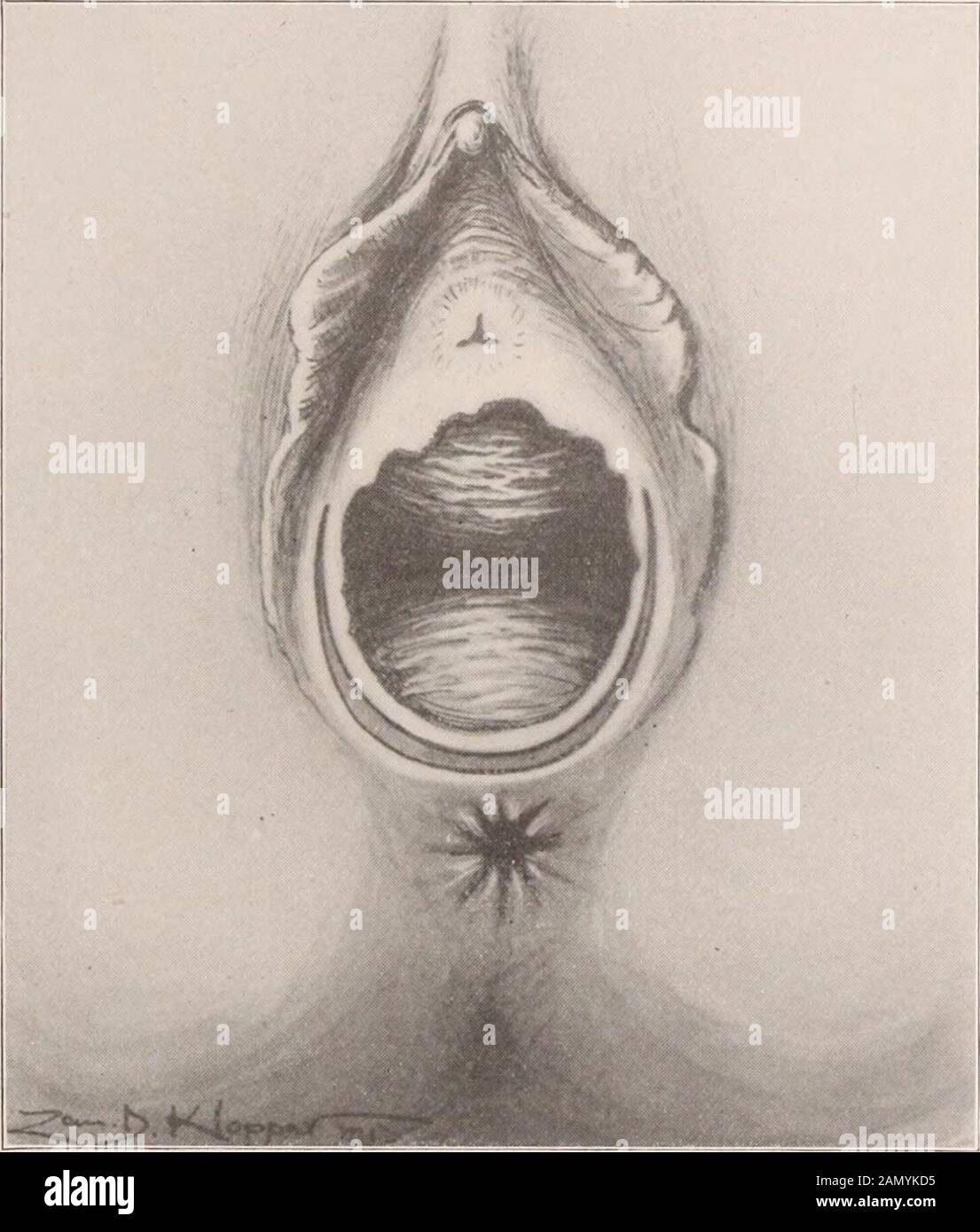 Transazioni dell'American Association of Ostetrichi e ginecologi per l'anno ... m). Fascia superficiale (), e sezioni del bulbocavernosus e muscoli ischiocavernosus (f), che compongono insieme lo strato esterno. La fascia esterna (&lt;/), la fascia interna (?), e il muscolo perineo profondo trasverso (/) tra questi, insieme constituutingil diaframma fascial. Il muscolo levatore ani, il più interno, e capo (g). Fig. 3 mostra questo diaframma urogenitale, il trigone, o il legamento triangularent. Il suo strato di fascia esterna è stato rimosso sulle LACERAZIONI lato destro del PERINEU Foto Stock