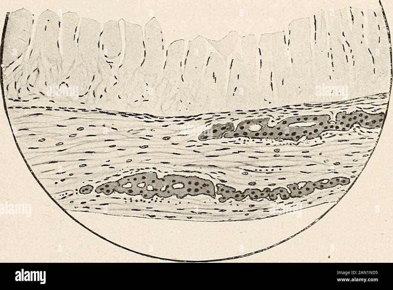 Ginecologia per studenti e praticanti . Fig. 361. Composto bilaterale Cisti Theca-luteik di un caso di Vesicijlar Mole, seguito da corionepithelioma. Di un cranio fetale. In generale un composto teca-luteina cisti. Fig. 362. Parete di Un Loculo di Un Composto Theca-luteina Ctst, che mostra il contenuto di fluido albuminoso indurito mediante soluzione di formalina. Il tessuto luteina è rappresentato da due lamine che sono state spostate dalla superficie interna e giacciono nel tessuto fibroso che compone la cisti-parete. Assomiglia ad un composto idrofps folliculorum o a un grande Rokitanskinciamo. I loculi possiedono ex Foto Stock