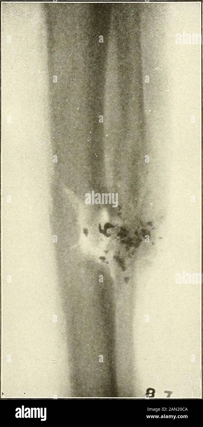 Lesioni da sparo : come vengono inflitte : le loro complicazioni e trattamento . Fig. 67.-Frattura da Colts nuovo revolver di servizio, proiettile non incamiciato, .38 cal. A 5 yarde. Collezione Della Scuola Medica Dell'Esercito. LESIONI CARATTERISTICHE CAUSATE DA PROIETTILI 91. Fig. -Frattura da proiettile con naso morbido, pistola automatica Colts Cal. 38 a 5 parametri di nucleo conduttore, frammentati. Collezione Della Scuola Medica Dell'Esercito. Nota Lodge- 92 FERITE DA SPARO effetti Esplosivi in ferite da sparo a intervalli prossimali da parte dei fucili ad alta potenza sono stati citati all'inizio di questo capitolo, pag.37. Sono stati notati da tutti gli sperimentatori Foto Stock