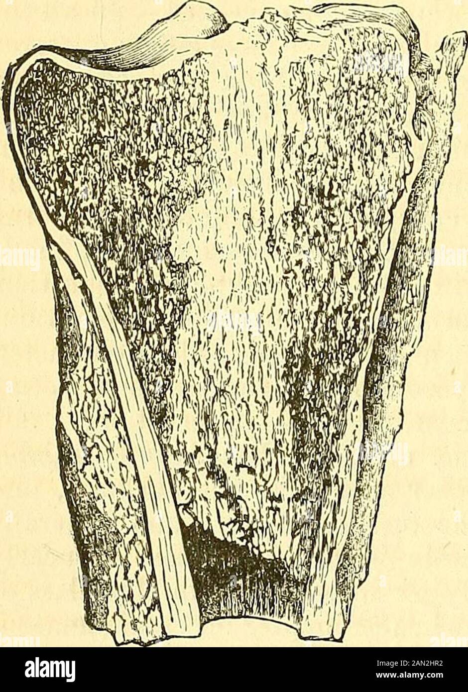 Un sistema di chirurgia : patologica, diagnostica, terapeutica, e operativa . n la fase avanzata del fthisis, di colore giallastro pallido, che si affaccia leggermente sul verdastro, e di consistenza fluida sottile, con piccole scaglie biancastre non a differenza dei grani di riso soft-boiledgrane. Dopo che un'apertura è stata effettuata nell'ascesso, il dischargenerally diventa molto acquoso e sanguinoso, così come irritante, e viene awayin grandi quantità, un certo numero di seni spesso esistenti nelle parti malate, asif che erano necessari per portare via le secrezioni superabbondanti. In molti casi, scomposto-giù osseous t Foto Stock