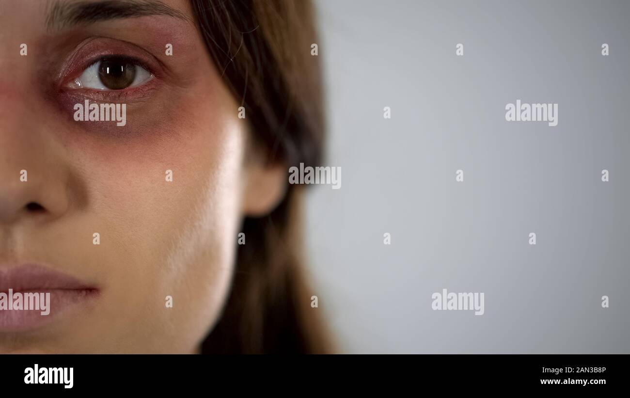Triste signora con la faccia di contusione guardando la fotocamera, la violenza, la discriminazione di genere Foto Stock